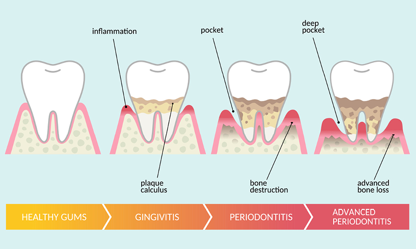 colorful depiction of various types of gum disease