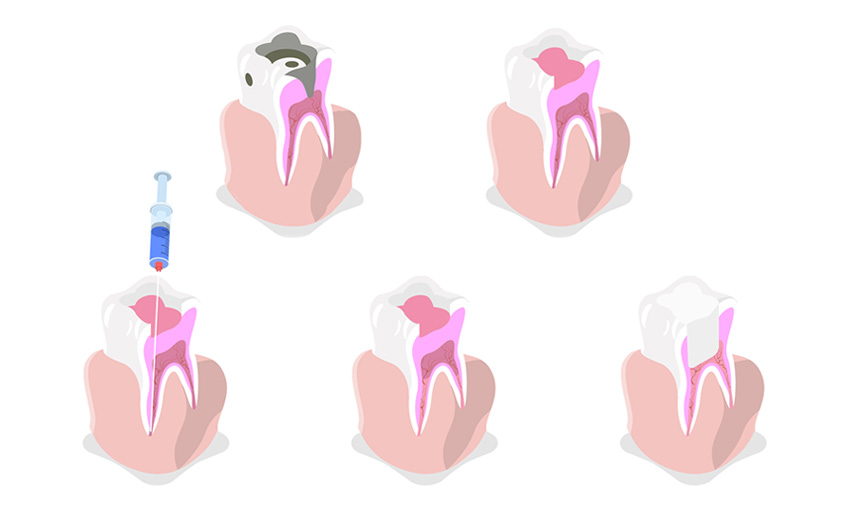 Root Canals and Dental Crowns: What to Know, What to Expect