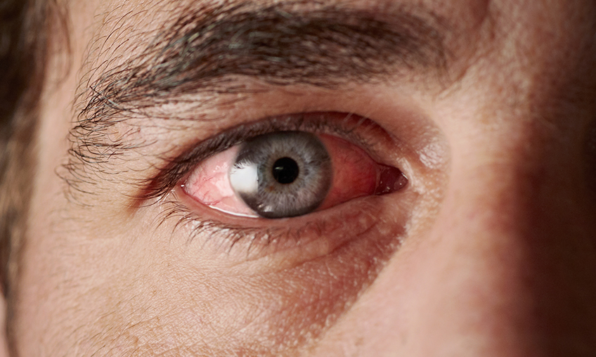 Closeup of irritated red bloodshot eye